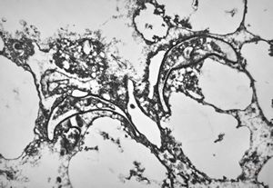 M,50y. | Pneumocystis carinii - lung